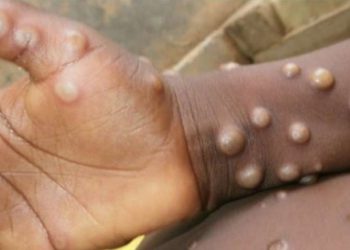 Sağlık Bakanlığı: Maymun Çiçeği vakası görülmedi