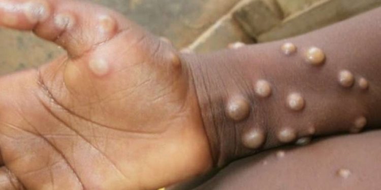 Sağlık Bakanlığı: Maymun Çiçeği vakası görülmedi