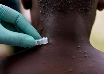 Sağlık Bakanlığı’ndan ‘maymun çiçeği’ açıklaması: Türkiye’de henüz görülmedi