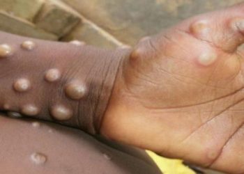 TTB'den maymun çiçeği  virüsü açıklaması: Hafife alınmamalıdır