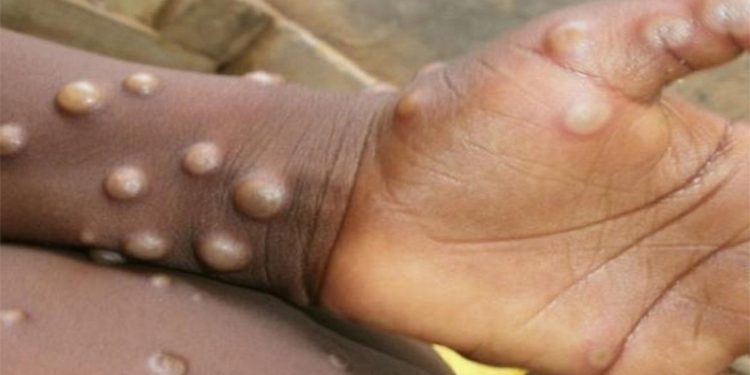 TTB'den maymun çiçeği virüsü açıklaması: Hafife alınmamalıdır