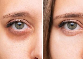 Uzmanı uyardı: Gözaltındaki mor halkalar basit bir cilt problemi olmayabilir