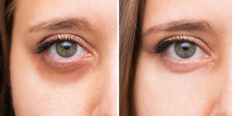 Uzmanı uyardı: Gözaltındaki mor halkalar basit bir cilt problemi olmayabilir