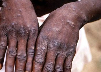 WHO: Dünya çapında doğrulanmış 80 maymun çiçeği vakası var