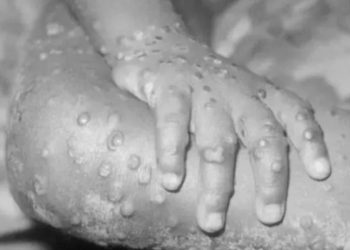 WHO ayrımcılık tehlikesine karşı uyardı: Maymun çiçeği virüsü cinsel yönelimle ilişkili değil