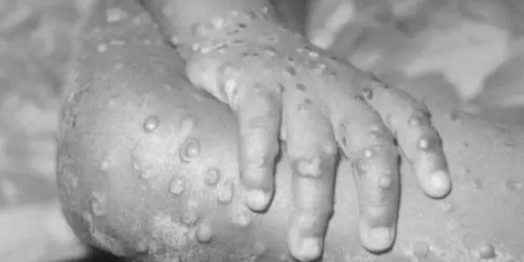 WHO ayrımcılık tehlikesine karşı uyardı: Maymun çiçeği virüsü cinsel yönelimle ilişkili değil