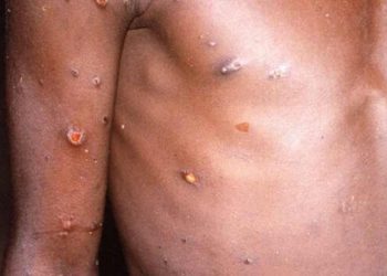 WHO'dan 'maymun çiçeği virüsü' açıklaması: Covid-19’dan farklı yayılıyor