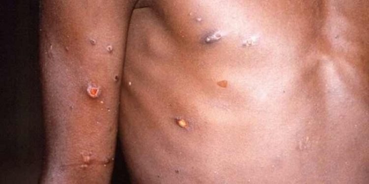 WHO'dan 'maymun çiçeği virüsü' açıklaması: Covid-19’dan farklı yayılıyor