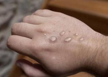 İrlanda, ülkede görülen ilk maymun çiçeği vakasını duyurdu