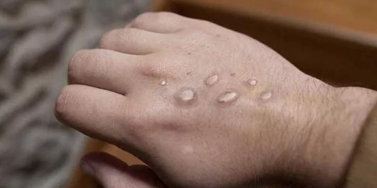 İrlanda, ülkede görülen ilk maymun çiçeği vakasını duyurdu