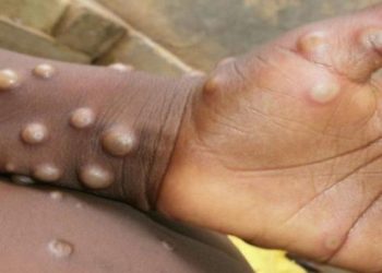 İsrail’de ilk maymun çiçeği vakası bildirildi