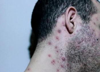 Brezilya'da ilk maymun çiçeği vakası görüldü