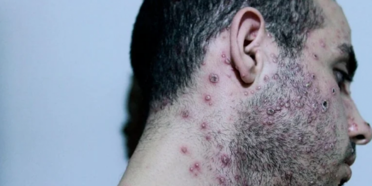 Brezilya'da ilk maymun çiçeği vakası görüldü