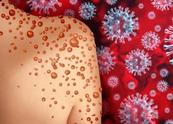 Komşuda ilk vaka: Yunanistan'da maymun çiçeği görüldü