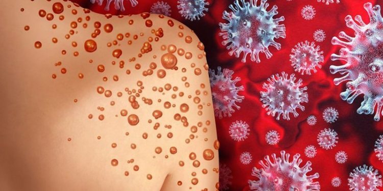 Komşuda ilk vaka: Yunanistan'da maymun çiçeği görüldü