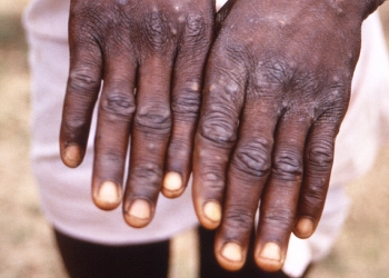 Maymun çiçeği virüsü: 'Kabus değil ama kötü bir rüya olabilir'