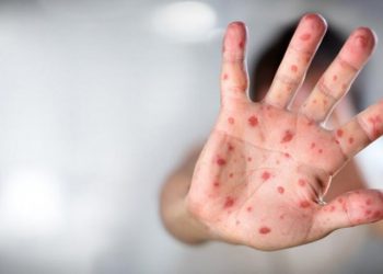 Maymun çiçeği virüsünün ismi değişiyor