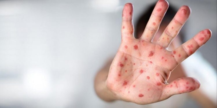 Maymun çiçeği virüsünün ismi değişiyor