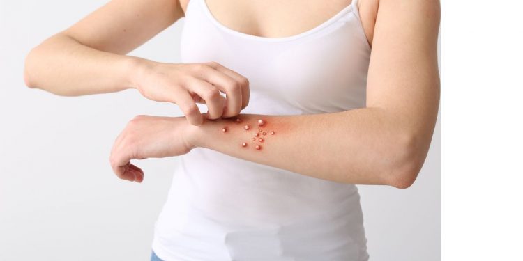 Türkiye’de ilk vaka görüldü: Hangi ülkede ne kadar maymun çiçeği vakası var?