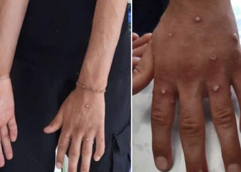 İstanbul Sultangazi’de maymun çiçeği şüphesi