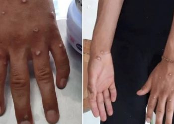 İstanbul’da ‘maymun çiçeği virüsü’ alarmı; test sonuçları negatif çıktı