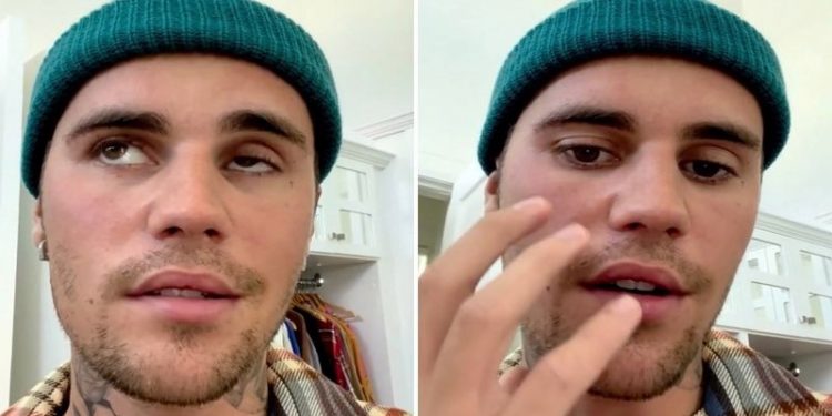 Şarkıcı Justin Bieber kısmi yüz felci geçirdi