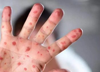 Belçika'da maymun çiçeği vakaları bir ayda üç kattan fazla arttı