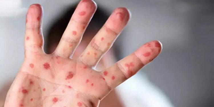 Belçika'da maymun çiçeği vakaları bir ayda üç kattan fazla arttı