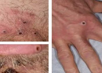 DSÖ: Dünya genelinde maymun çiçeğinden 3 kişi öldü