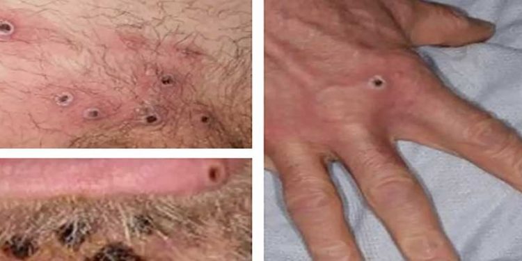 DSÖ: Dünya genelinde maymun çiçeğinden 3 kişi öldü