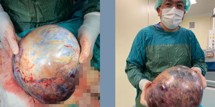 Nefes darlığı şikayetiyle gitti, karnından 10 kilo tümör çıkarıldı