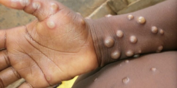 New York’ta ‘maymun çiçeği’ salgını nedeniyle OHAL ilan edildi