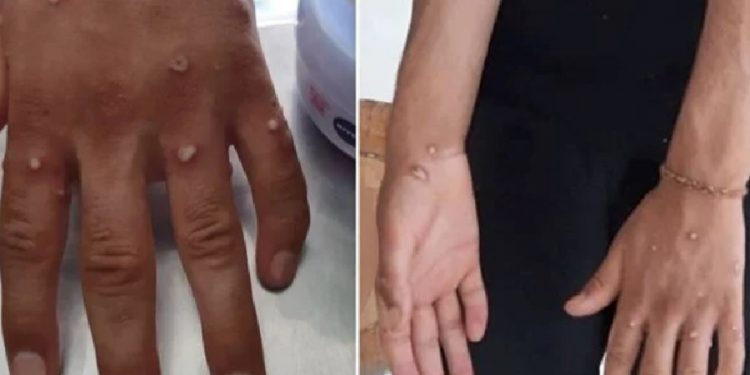 Sağlık Bakanlığı’ndan ‘maymun çiçeği virüsü’ rehberi