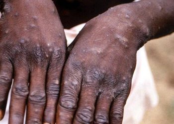 WHO: Küresel maymun çiçeği vakalarının sayısı 18 bini aştı