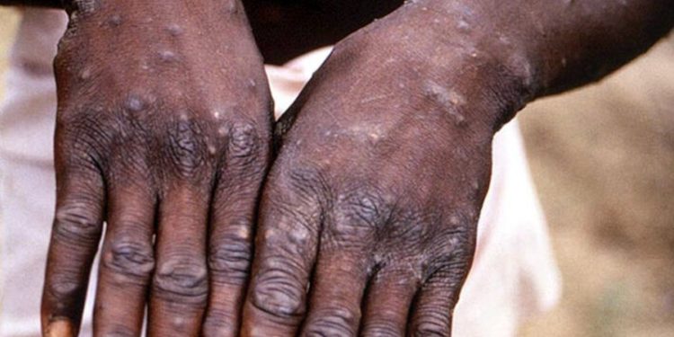 WHO: Küresel maymun çiçeği vakalarının sayısı 18 bini aştı