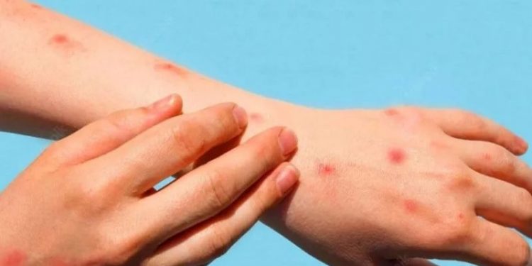 Domates gribi: En az 82 çocukta tespit edildi