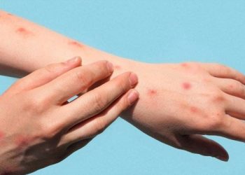 Dünyada maymun çiçeği vaka artışları son bir haftada yüzde 21 azaldı