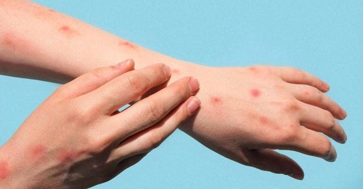 Dünyada maymun çiçeği vaka artışları son bir haftada yüzde 21 azaldı