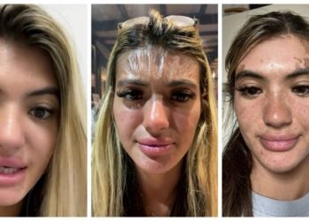 Güneşin altında uyuyakaldı, yüzü 'plastik' gibi gerildi!