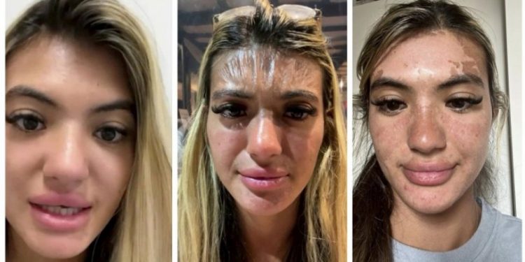 Güneşin altında uyuyakaldı, yüzü 'plastik' gibi gerildi!