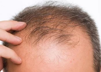 Saçı dökülen erkekler ve kadınlar için yeni umut