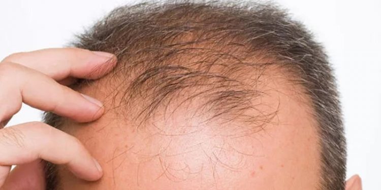 Saçı dökülen erkekler ve kadınlar için yeni umut