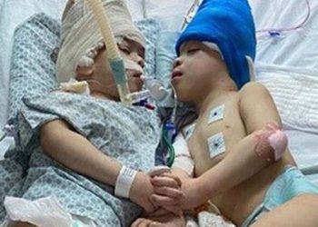 Yapışık ikizler 27 saatlik operasyonla ayrıldı