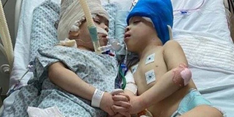 Yapışık ikizler 27 saatlik operasyonla ayrıldı