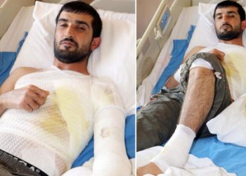 Epilepsi nöbeti geçirirken, kaynayan çorba kazanına düştü
