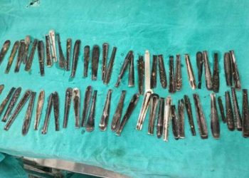 Karın ağrısı şikayetiyle hastaneye gitti; midesinden 60'tan fazla metal kaşık çıktı