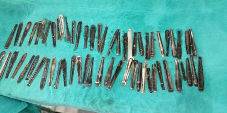 Karın ağrısı şikayetiyle hastaneye gitti; midesinden 60'tan fazla metal kaşık çıktı