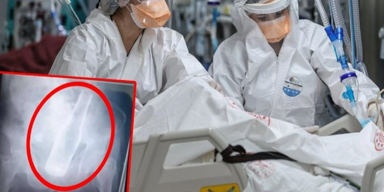 79 yaşındaki adam, makatında bira şişesiyle acile gitti: Hırsızlar yaptı