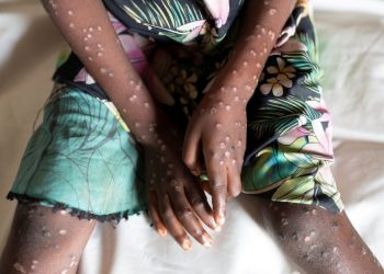 DSÖ, maymun çiçeği hastalığının adını değiştirdi: Mpox