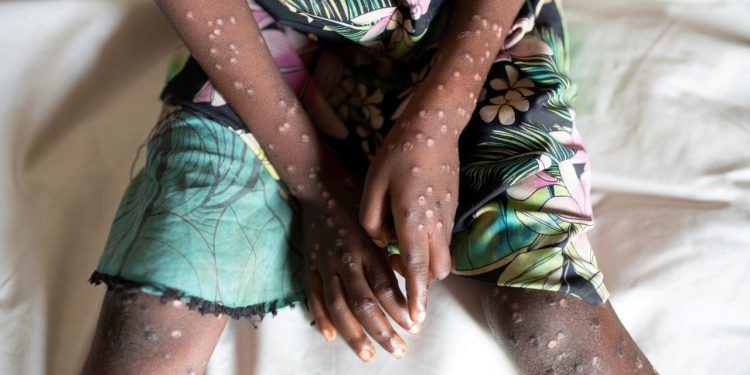 DSÖ, maymun çiçeği hastalığının adını değiştirdi: Mpox